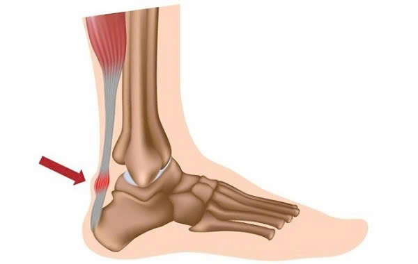 Cảnh báo nguy cơ viêm gân do thuốc